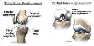 Knee Replacement Surgery