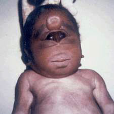 Cyclopia