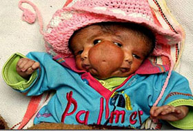 craniopagus-parasiticus