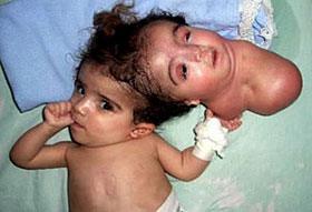 craniopagus-parasiticus3