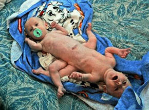 siamese-twins