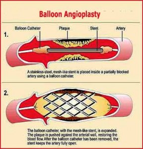 balloon-angioplasty Balloon Angioplasty