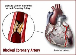 Blocked Coronary Artery