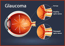 Glaucoma