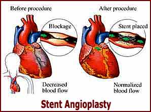 Stent Angioplasty