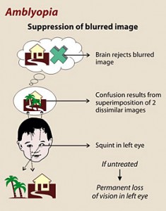 Amblyopia