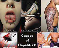 hepatitisc