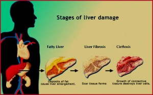 liver-damage-stages