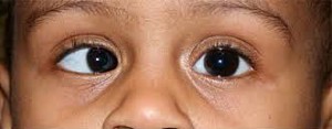 Strabismus