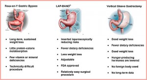 types-weight-loss-surgery