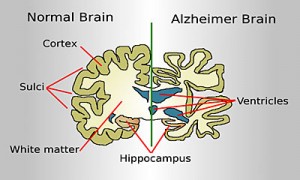 Brain-Alzheimers-maternal-link