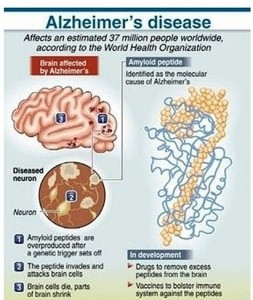 alzheimers-disease