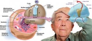 alzheimers-disease-triggered-by-protein