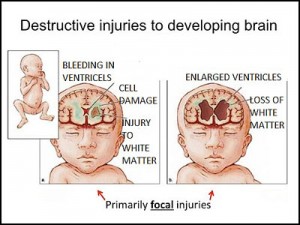 brain_injury