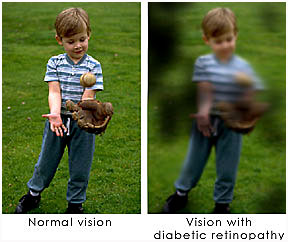 diabetic-retinopathy