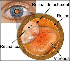 retinal-detatchment