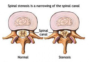 spinal-stenosis