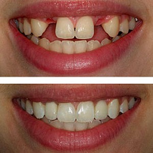dental-implant-before-and-after