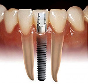 Dental Implants