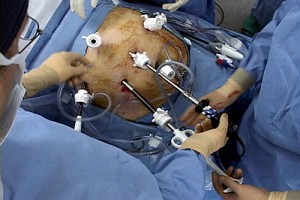 Robotic Surgery In India