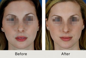 Chin Implant Before and After