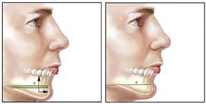 Chin Augmentation Surgery