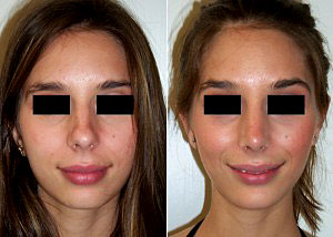 Chin Augmentation