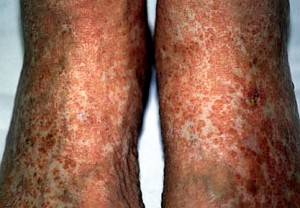 Skin Problems in Chronic Kidney Disease