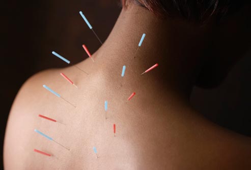 What Is Acupuncture?