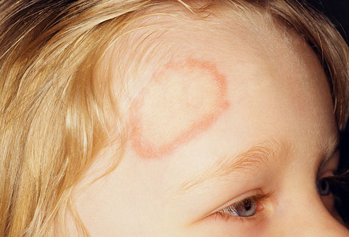 What does the term ‘Ringworm’ mean?
