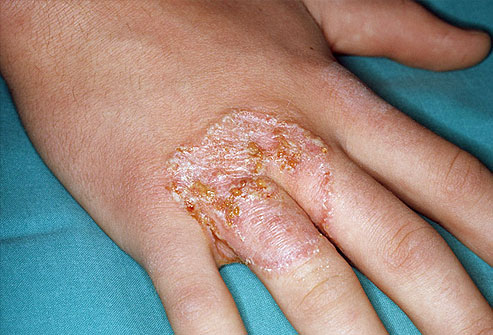 Tinea Manus (Ringworm of the Hand)