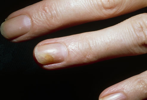 Tinea Unguium (Ringworm of the Nails)