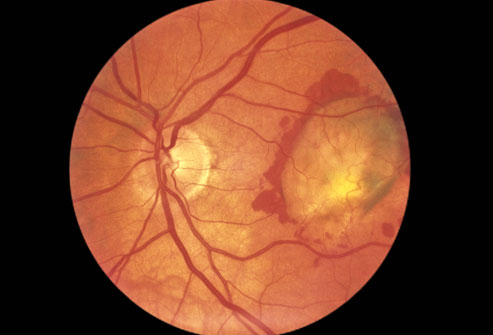 What happens to the eye in Glaucoma?