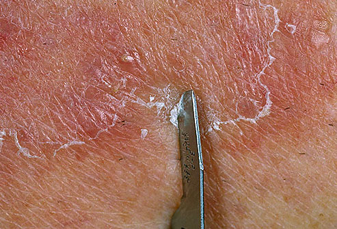 How can ringworm be diagnosed?