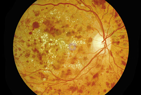Diabetic Retinopathy: How does it effect?