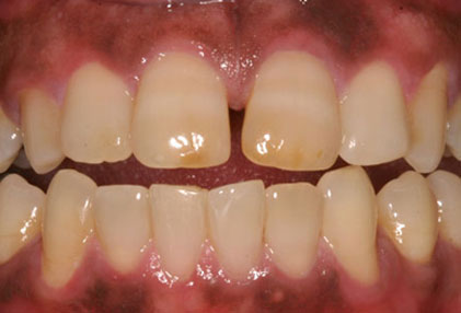 Gum Diseases and Diabetes