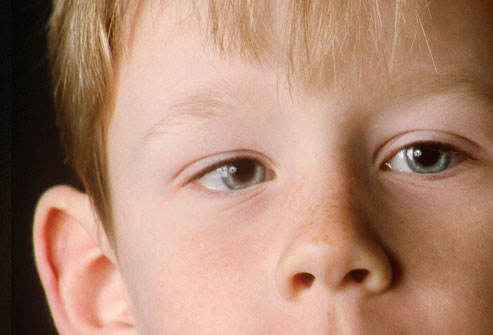 Amblyopia (Lazy eye)