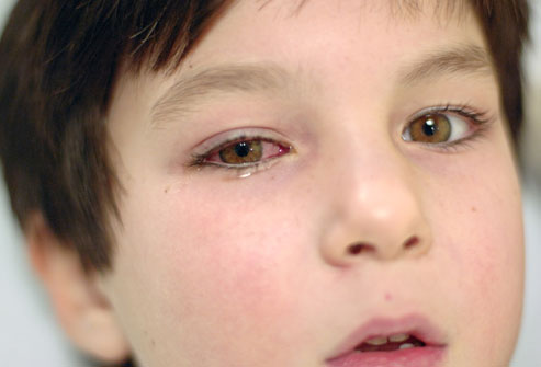 Pink eye (Conjunctivitis)