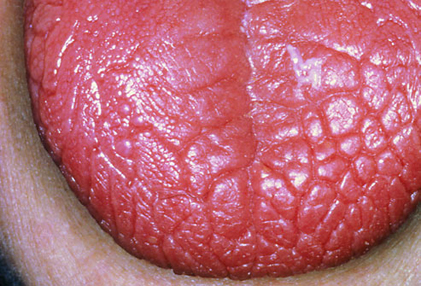 Dry Mouth and Tongue can cause Tooth Decay