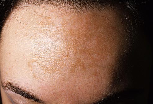 Melasma