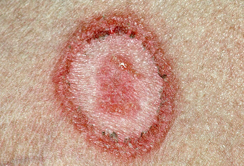 What are the reasons of ringworm?