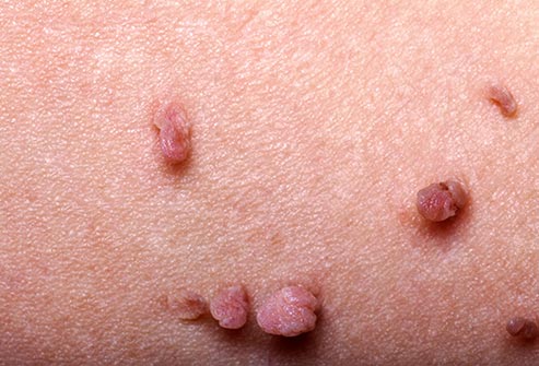 Skin Tags