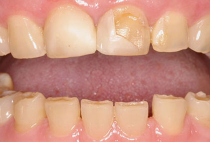 Stress and Teeth Grinding