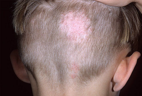 Tinea Capitis (Ringworm of the Scalp)