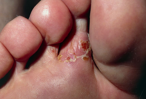 Tinea Pedis (Ringworm of the Foot)