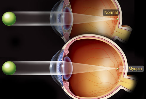 Near sightedness: What Happens?