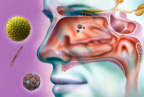 What Causes Sinus Problems