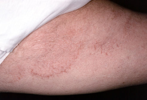 Tinea Cruris (Ringworm of the Groin)