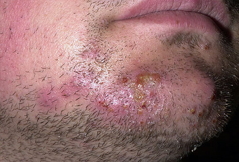 Tinea Barbae (Ringworm of the Beard)