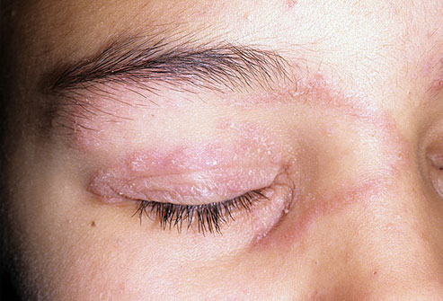 Tinea Faciei (Ringworm of the Face)